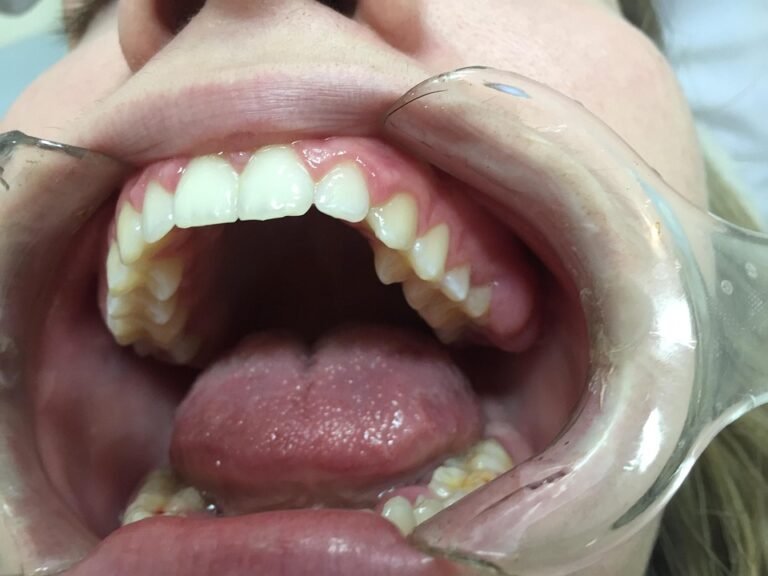 What is the ideal aperture for capturing dental details