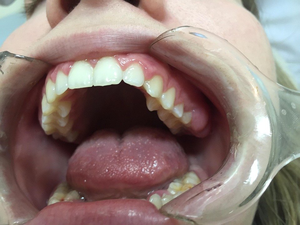 What is the ideal aperture for capturing dental details