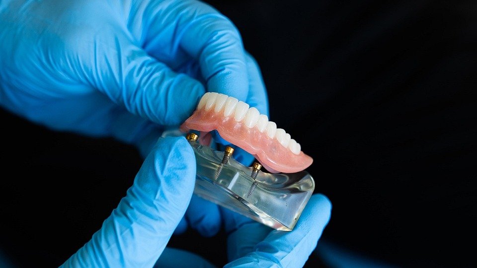 Are there any new trends in dental veneers