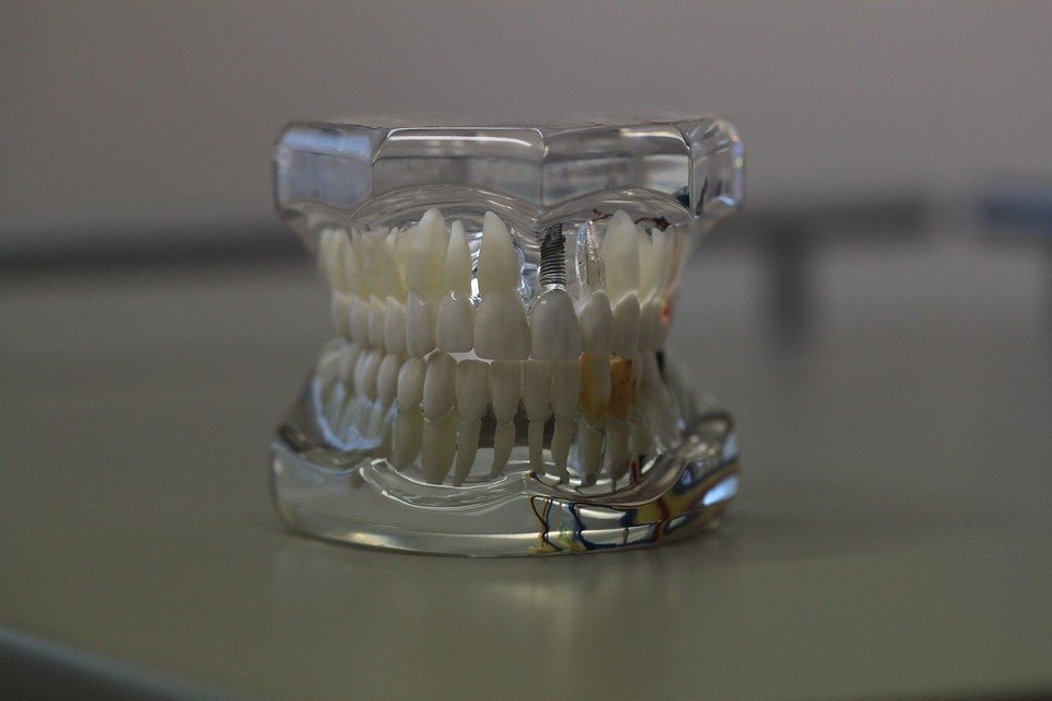 How is 3D printing related to dental models? How is 3D printing related to dental models?