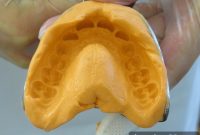 Holly Springs Smile Design Balancing Speed and Longevity