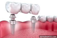Implant Bridges or Dentures A Guide to a Confident Smile