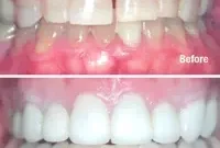 Beyond the Gray A Tetracycline Smile Transformation
