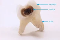 Decoding the Signals of Tooth Decay