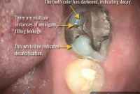 Knowing When Your Amalgam Fillings Need an Upgrade