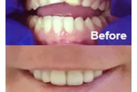 Revitalize Your Smile from Severe Erosion with Dental Crowns