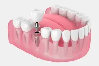 Permanent Implant Solutions for a Complete Smile