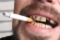 Decoding the Dark Stains on a Smokers Smile