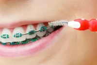 Your Roadmap to a Radiant Smile with Braces