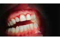 Bleeding Gums Are A Warning Sign