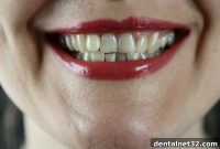 Warning Signs of a Developing Cavity