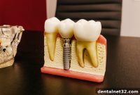 Demystifying Dental Implants Cost Process and Results