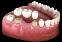 Transforming Smiles with Crowns and Bridges