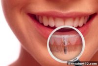 Choosing a Dental Implant Specialist in Locust NC