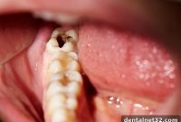Transforming Tooth Decay Treatment Through Technological Innovation