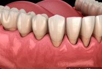 Gum Recession Explained Causes Symptoms and Solutions