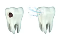 Understanding Cavity Progression The Five Stages of Decay