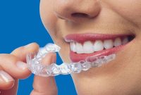 Your 20 Point Invisalign Pre Treatment Guide