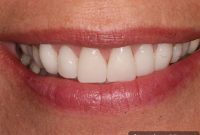 Your Guide to Stain Free Eating After Whitening