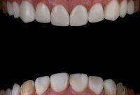 Decoding Tooth Discoloration Cavity or Stain