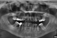 Demystifying Dental X Rays