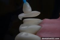 Gülüşünüz İçin Doğru Seçim Lamine mi Kaplama mı