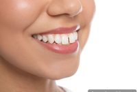 Your Dentists Guide to Overbite Correction