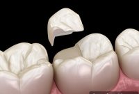 One Visit Crowns The Modern Alternative to Traditional Methods