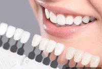 The Clear Advantages of Professional Whitening Over At Home Kits