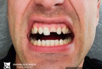 Your Action Plan for a Chipped Tooth