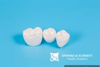 The Lifespan of a Dental Crown Explained