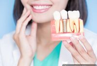 The Ultimate Guide to Dental Implants