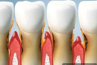 Identifying and Treating Receding Gums