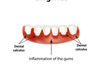 Gingivitis Explained Causes Symptoms and Effective Treatments