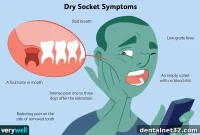 Decoding Dry Socket Your Path to a Smooth Recovery