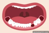 Your Roadmap to a Fast Tooth Extraction Recovery