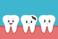 Decoding Tooth Decay A Guide from Cause to Cure