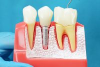 The Triple Defense Dental Implants Provide For Your Smile