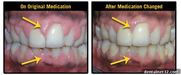 Close-up of medication-induced gingival overgrowth, showing swollen gums covering teeth