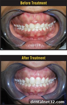 A close-up of a person's smile before and after gummy smile correction treatment
