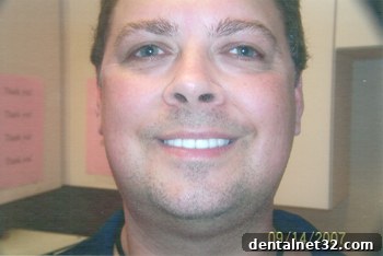 The final result of a smile makeover using porcelain crowns to cover tetracycline stains, showing a bright, white, and even smile.