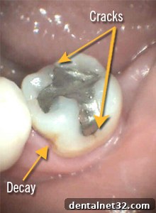 Illustration showing two cracks and a cavity on a molar tooth
