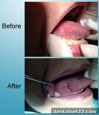 A patient's before and after photos showing the successful treatment of oral cancer on the tongue.