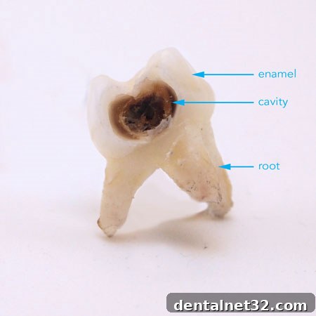 Close-up of a tooth with a severe cavity