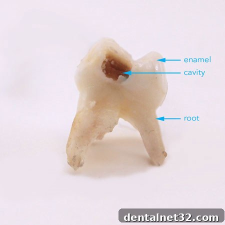 Illustration of plaque between two teeth leading to decay