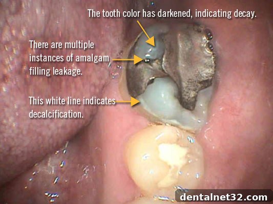 An old, leaking amalgam filling showing corrosion and underlying tooth decay.