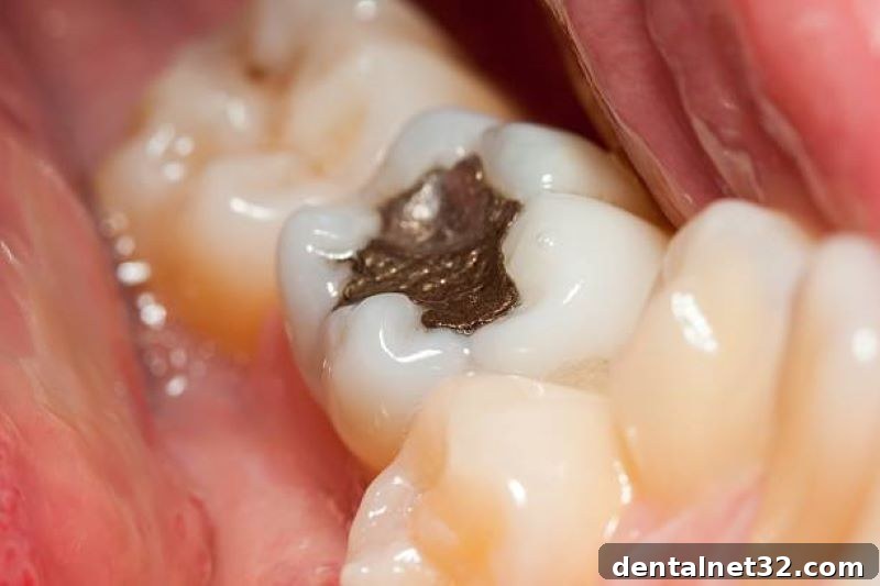 Fortify Your Teeth Against Decay 2 A detailed image showing the anatomy of a tooth with a cavity in Locust, NC