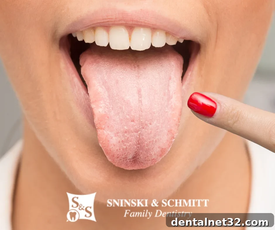 A close-up of a tongue with white patches, indicating a potential tongue disease.
