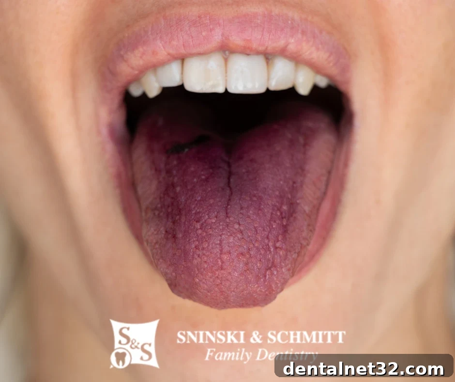 A tongue with a bright red appearance, which can be a symptom of certain tongue diseases.