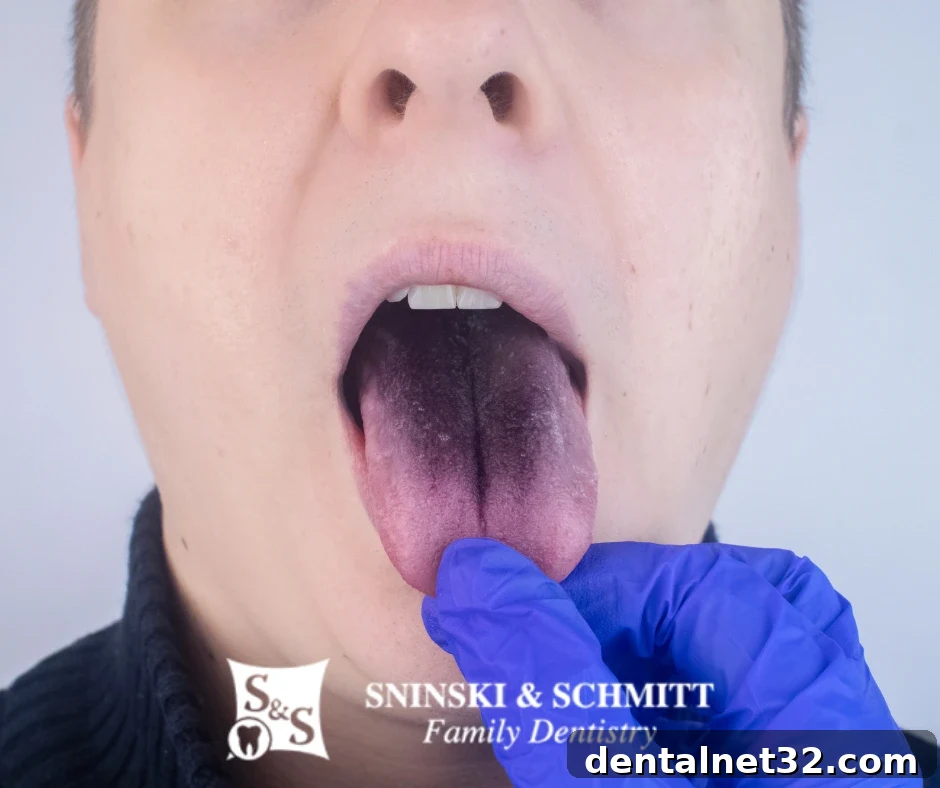 An example of a black hairy tongue, a harmless but visually striking tongue condition.